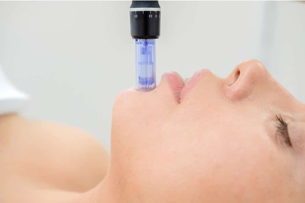 microneedling what is it and what does it treat 638798f1a3c04