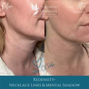 B&A Redensity in Necklace Lines