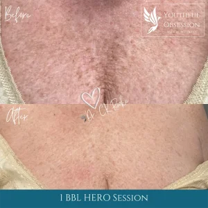 Before and After BBL HERO Chest and mouth