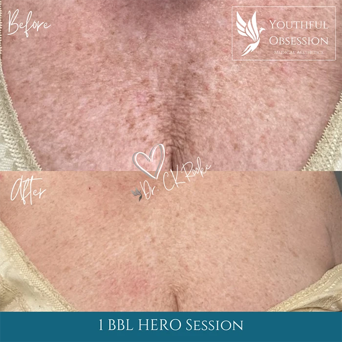 Before and After BBL HERO Chest and mouth