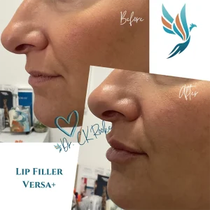 Lip Filler Versa plus