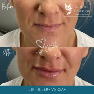 Lip Filler Versa plus front