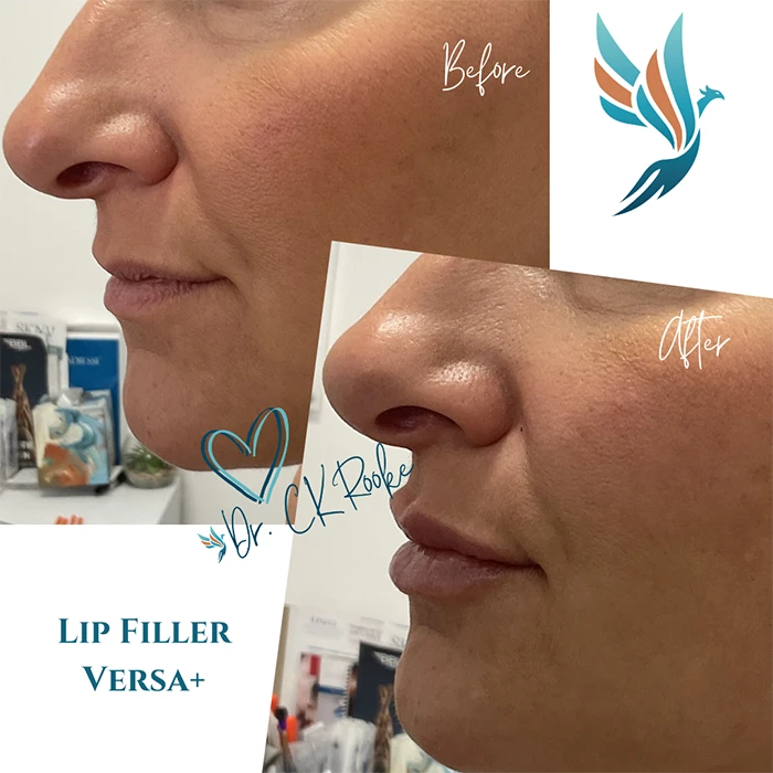 Lip Filler Versa plus