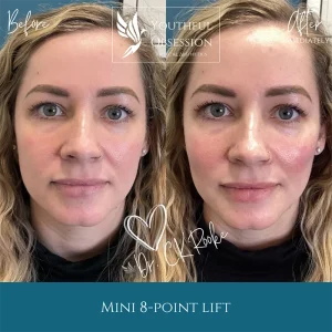 Mini 8 point Lift B&A front