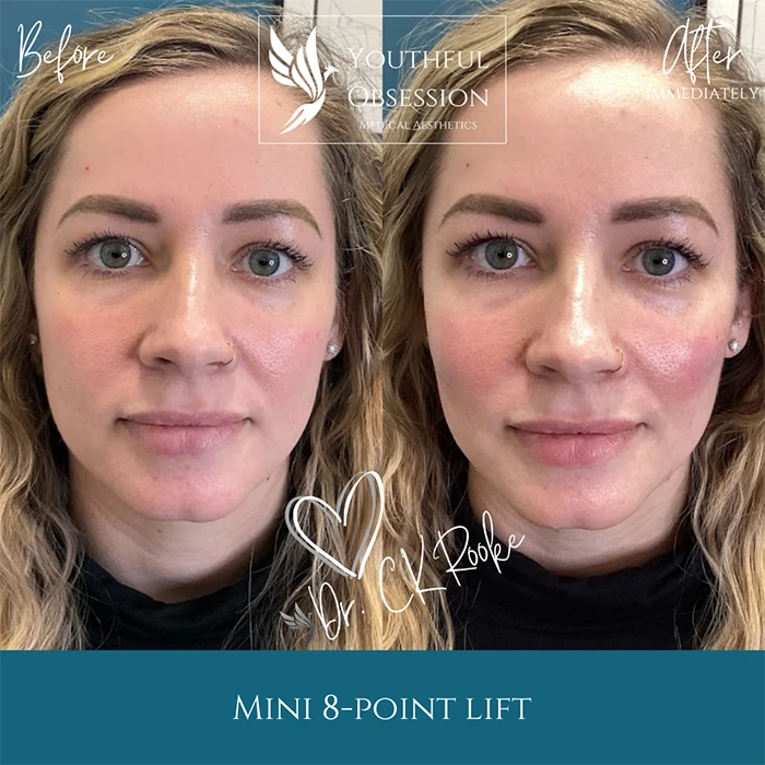 Mini 8 point Lift B&A front
