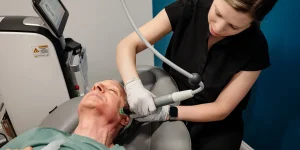 YO Microneedling Treatment